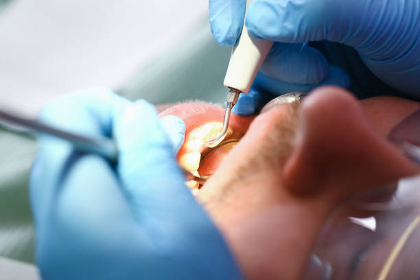 Best Broken or Cracked Tooth Emergency Dentist in Utica, IN