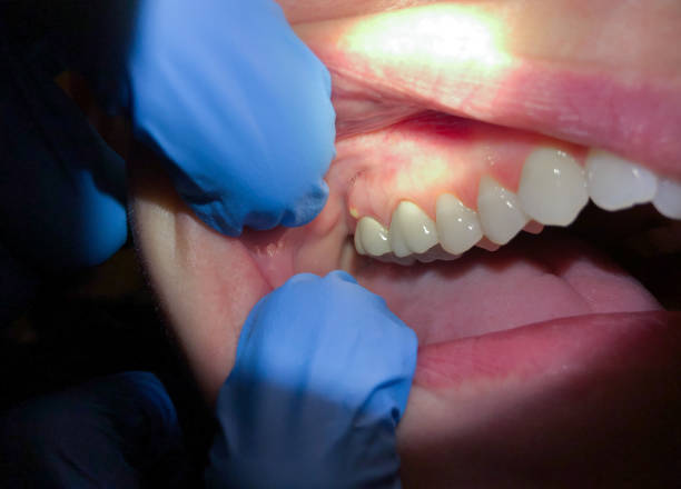Best Emergency Dentist for Knocked-Out Tooth in Utica, IN