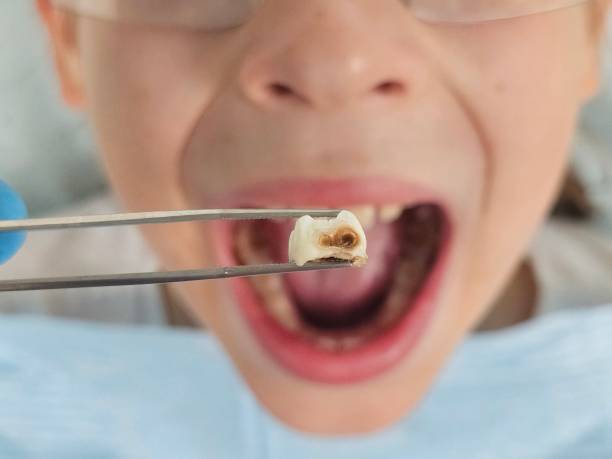 Best Emergency Root Canal Treatment in Utica, IN